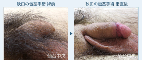 秋田の包茎手術 症例写真2