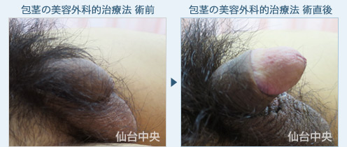 包茎の美容外科的治療法
