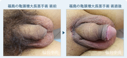 福島の亀頭増大長茎手術　症例写真1