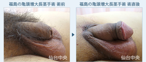 福島の亀頭増大長茎手術　症例写真2