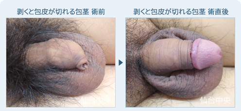 剥くと包皮が切れる包茎　症例写真1