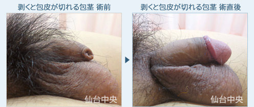 剥くと包皮が切れる包茎　症例写真2