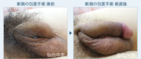 新潟の包茎手術 症例写真2